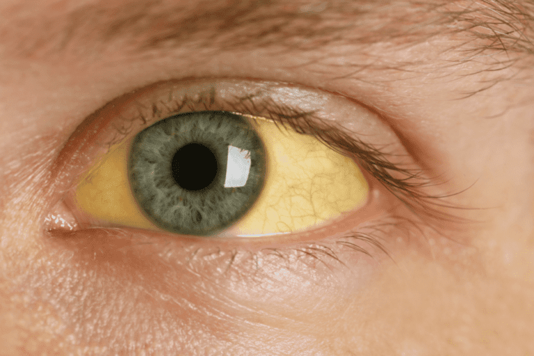 Close-up of a human eye with a yellowed sclera and a green iris, showing signs of jaundice often associated with meth eyes.